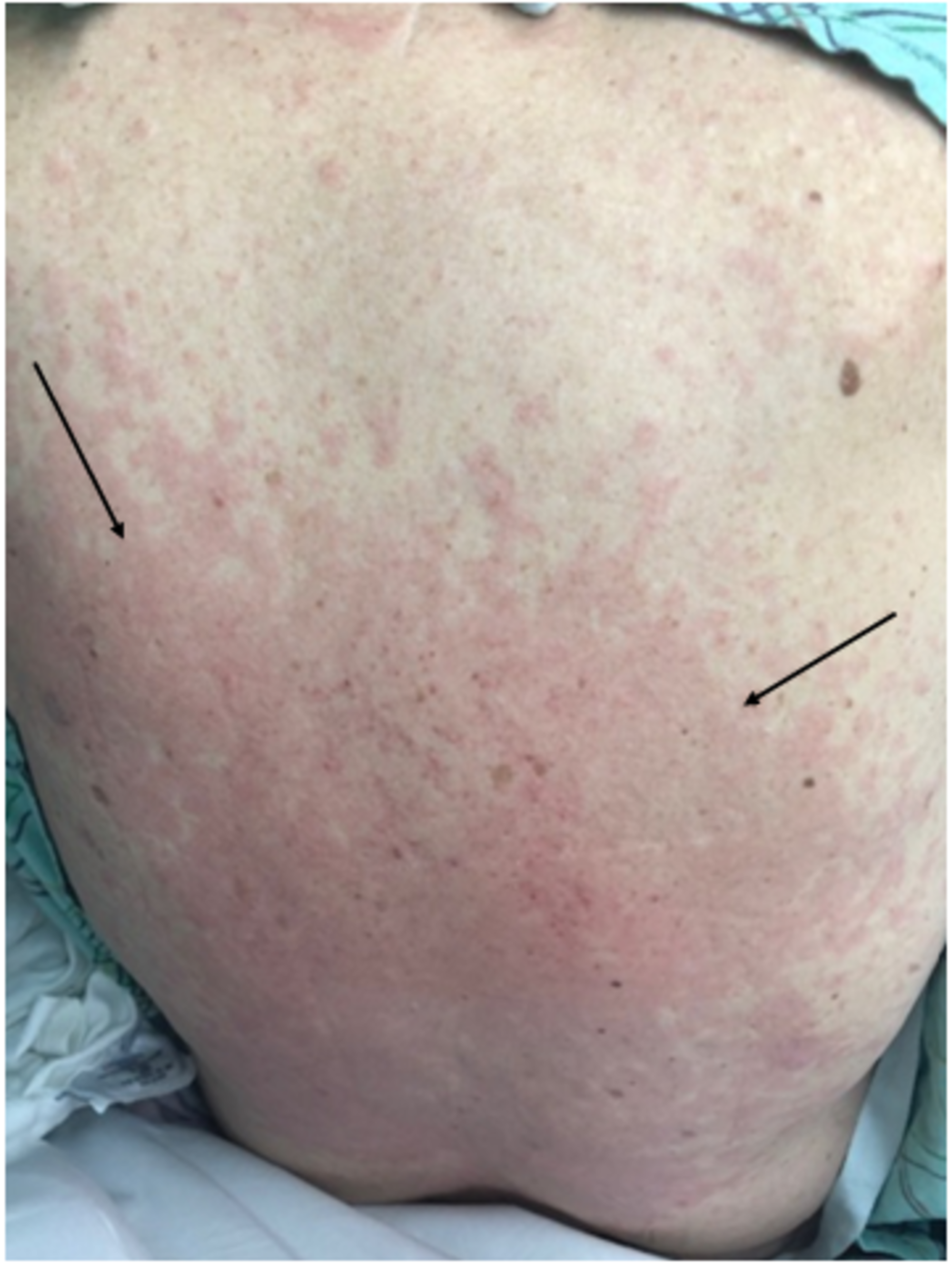 how-to-detect-subcutaneous-emphysema