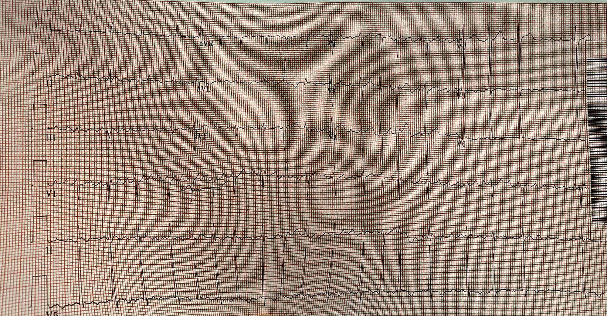 history of atrial flutter icd 10