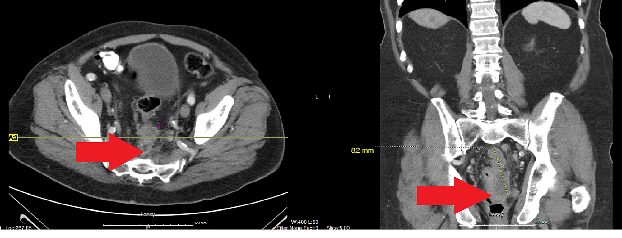 Cureus Metastatic Rectal Small Cell Carcinoma A Case Report 