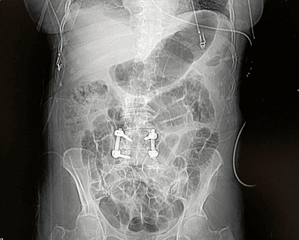 Postoperative-spinal-CT-scan