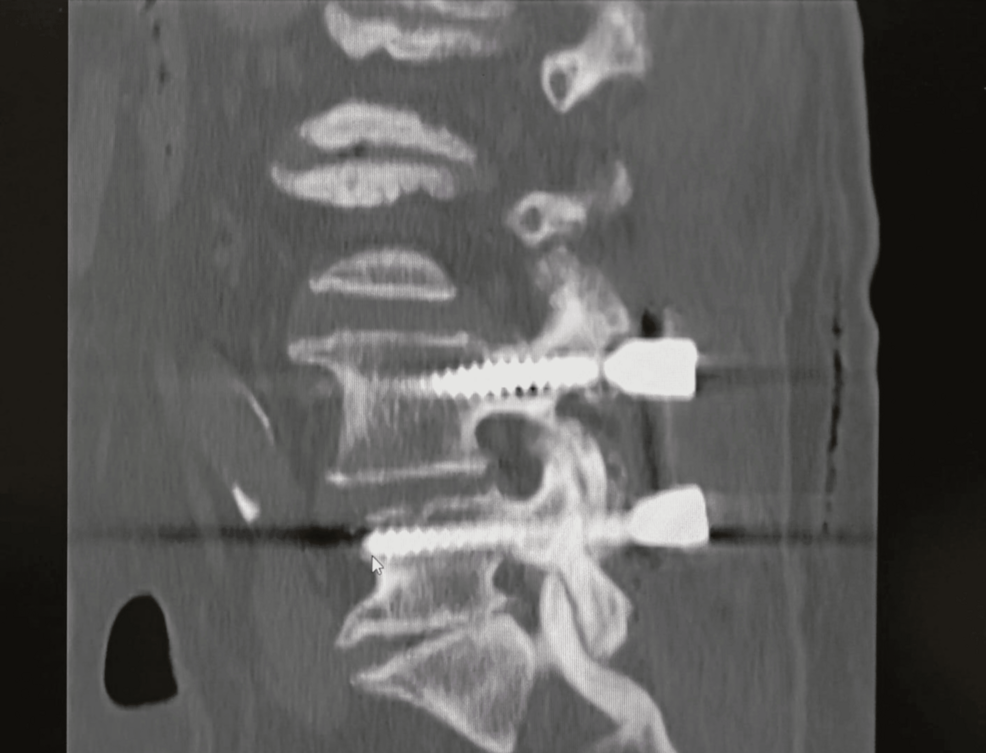 Postoperative-spinal-CT-scan