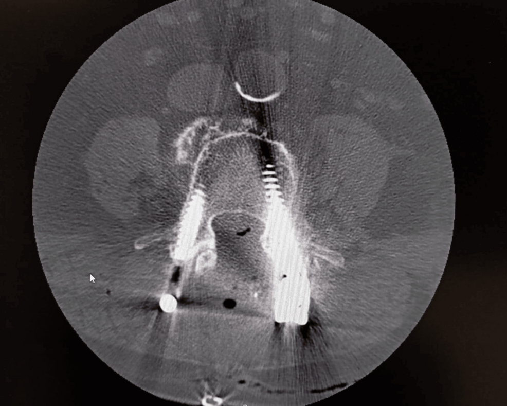 Postoperative-spinal-CT-scan