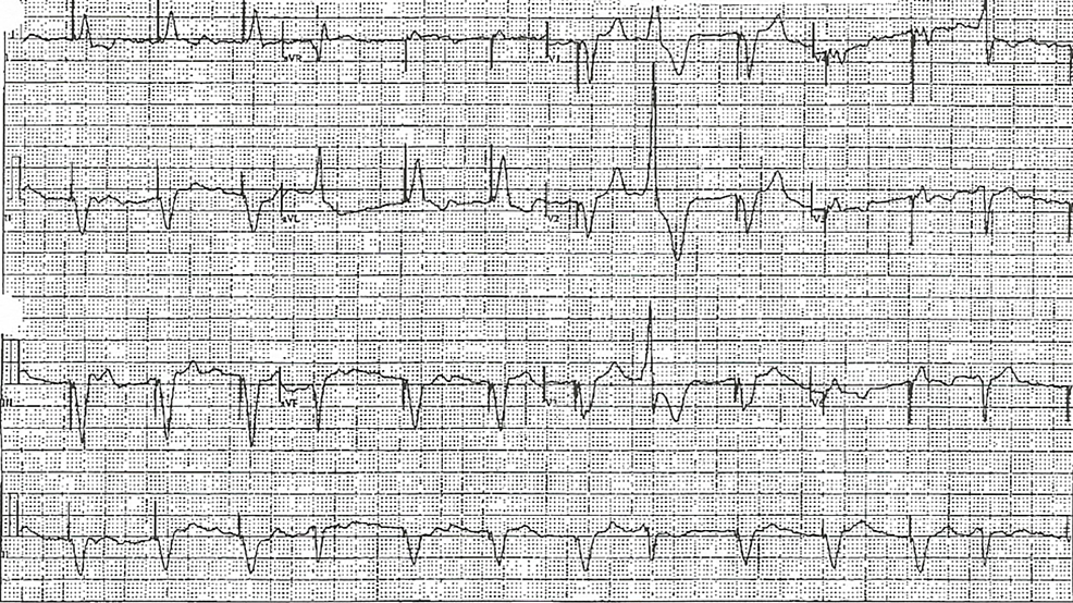 Cureus | Shock From Twisting Peaks: A Rare Case of Recurrent Torsades ...