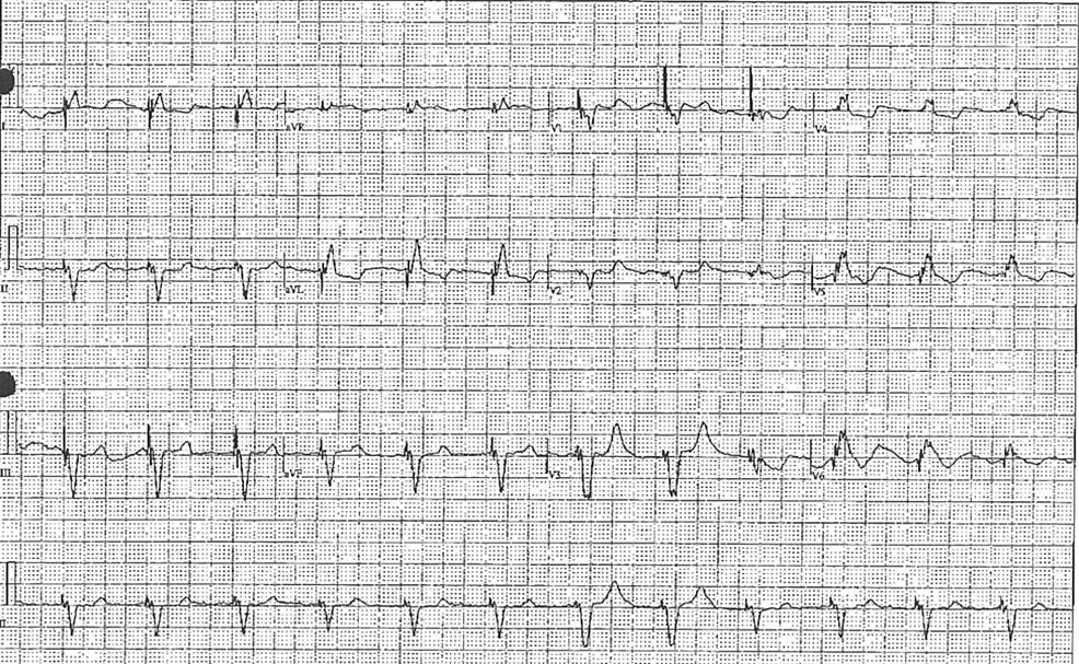 Cureus | Shock From Twisting Peaks: A Rare Case of Recurrent Torsades ...