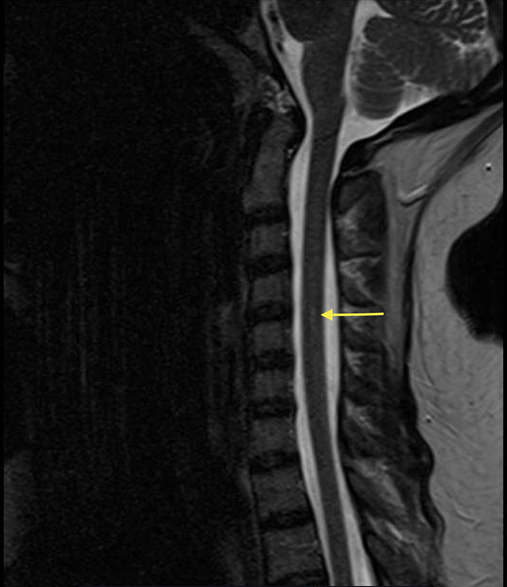 Cureus Nitrous Oxide Induced Vitamin B Deficiency Resulting In