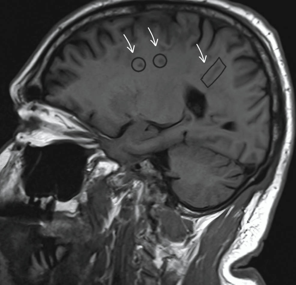 A Case of Pneumocephalus Due to an Untreated Atrial-Esophageal Fistula Post-Left Atrial Ablation Therapy