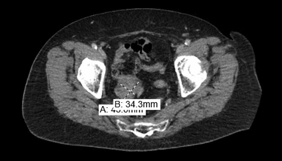 Cureus Recurrence Of Endometrial Stromal Sarcoma Two Decades Post