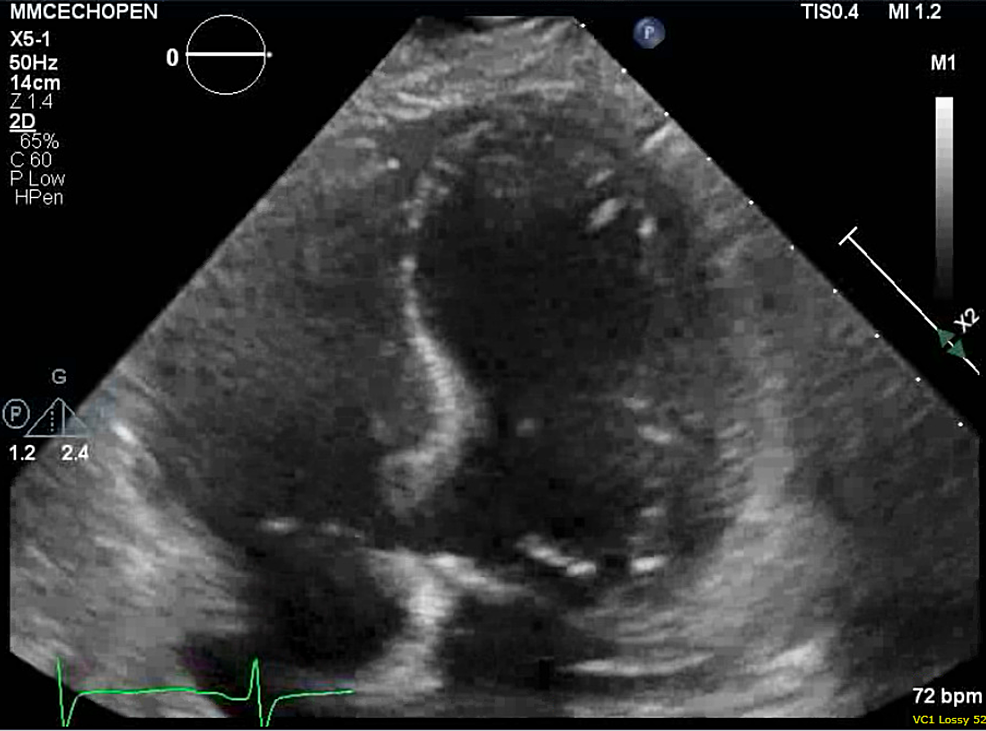 Cureus Takotsubo Cardiomyopathy And QTc Prolongation With Subsequent
