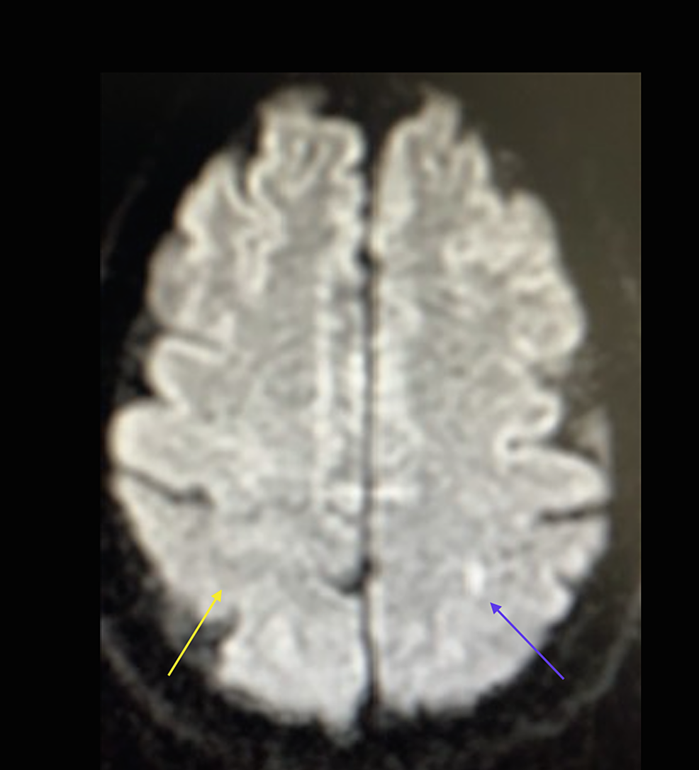 Ischemic Infarct of the Hand Knob Gyrus Natural History, Morphology, and Localizing Value of