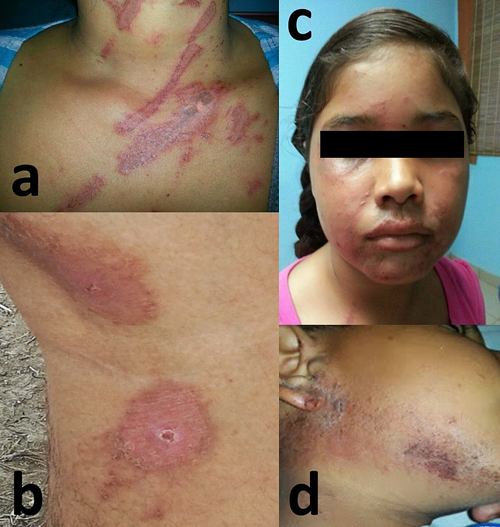 Cutaneous-manifestations-of-dermatitis-from-Paederus-observed-during-the-outbreak.-(a)-Vesicular-linear-dermatitis.-(b)-Mirror-lesion.-(c)-Multiple-vesicular-pustular-lesions-and-crust-lesions-in-the-face.-(d)-Multiple-vesicular-pustular-lesions-and-crust-lesions-in-the-periauricular-and-mandibular-areas