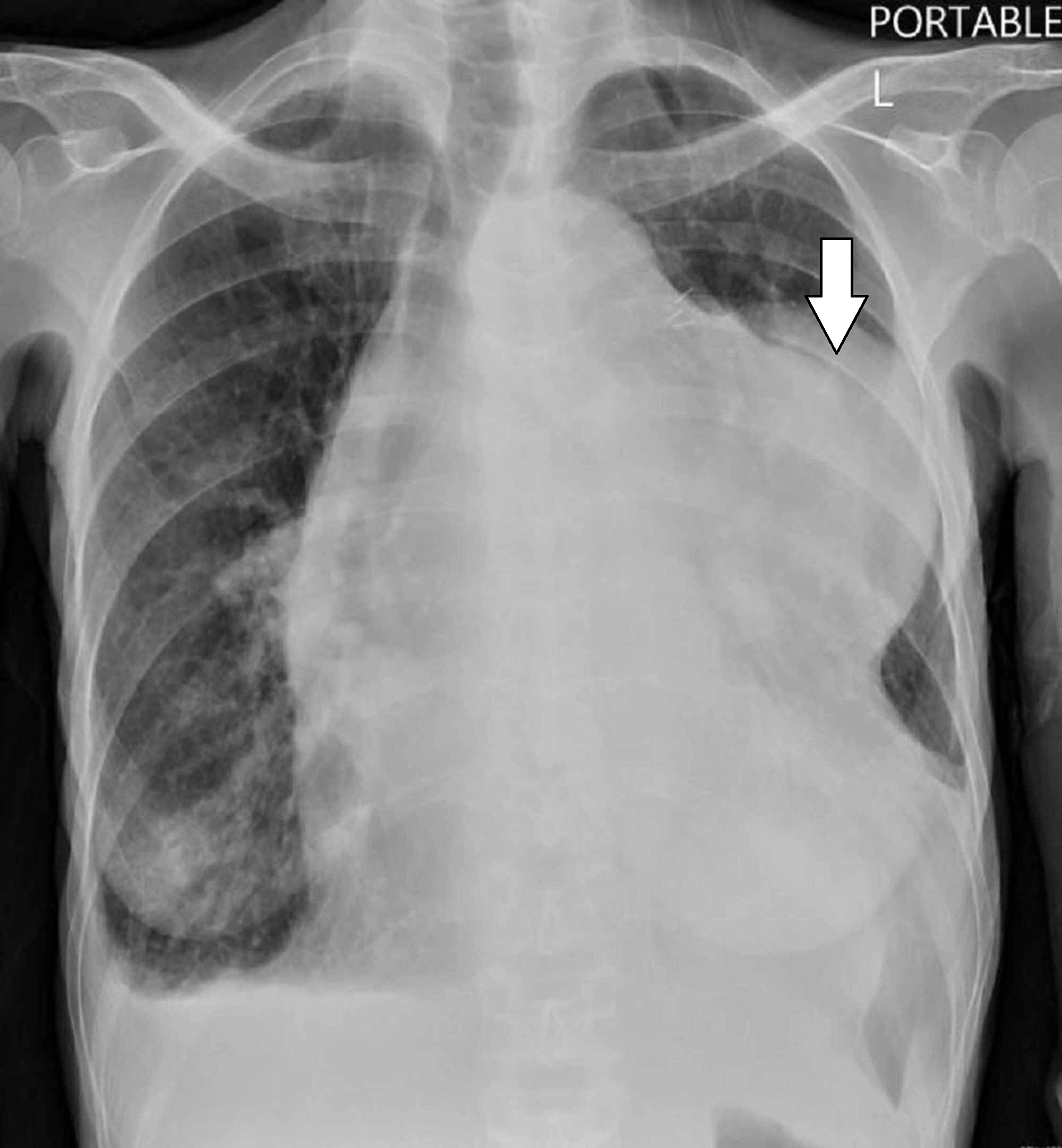 Cureus | Rare Acute Presentation of a Low-Grade Thymic Neuroendocrine Tumor