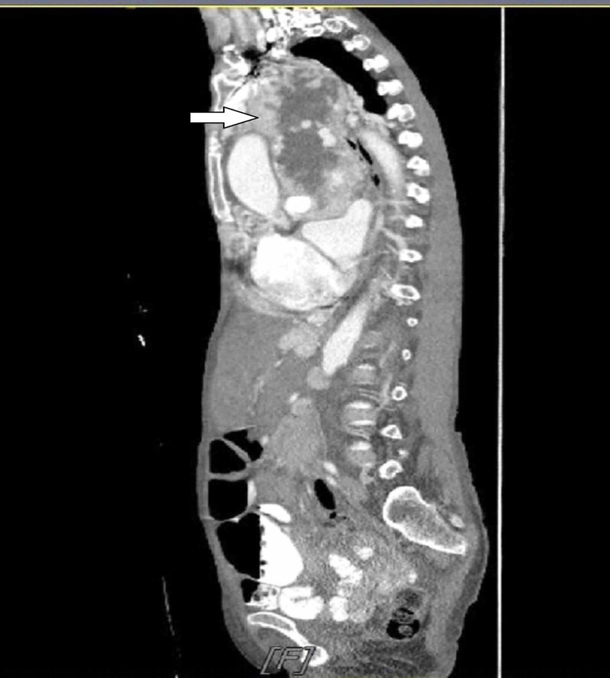 Cureus Rare Acute Presentation of a LowGrade Thymic Neuroendocrine Tumor