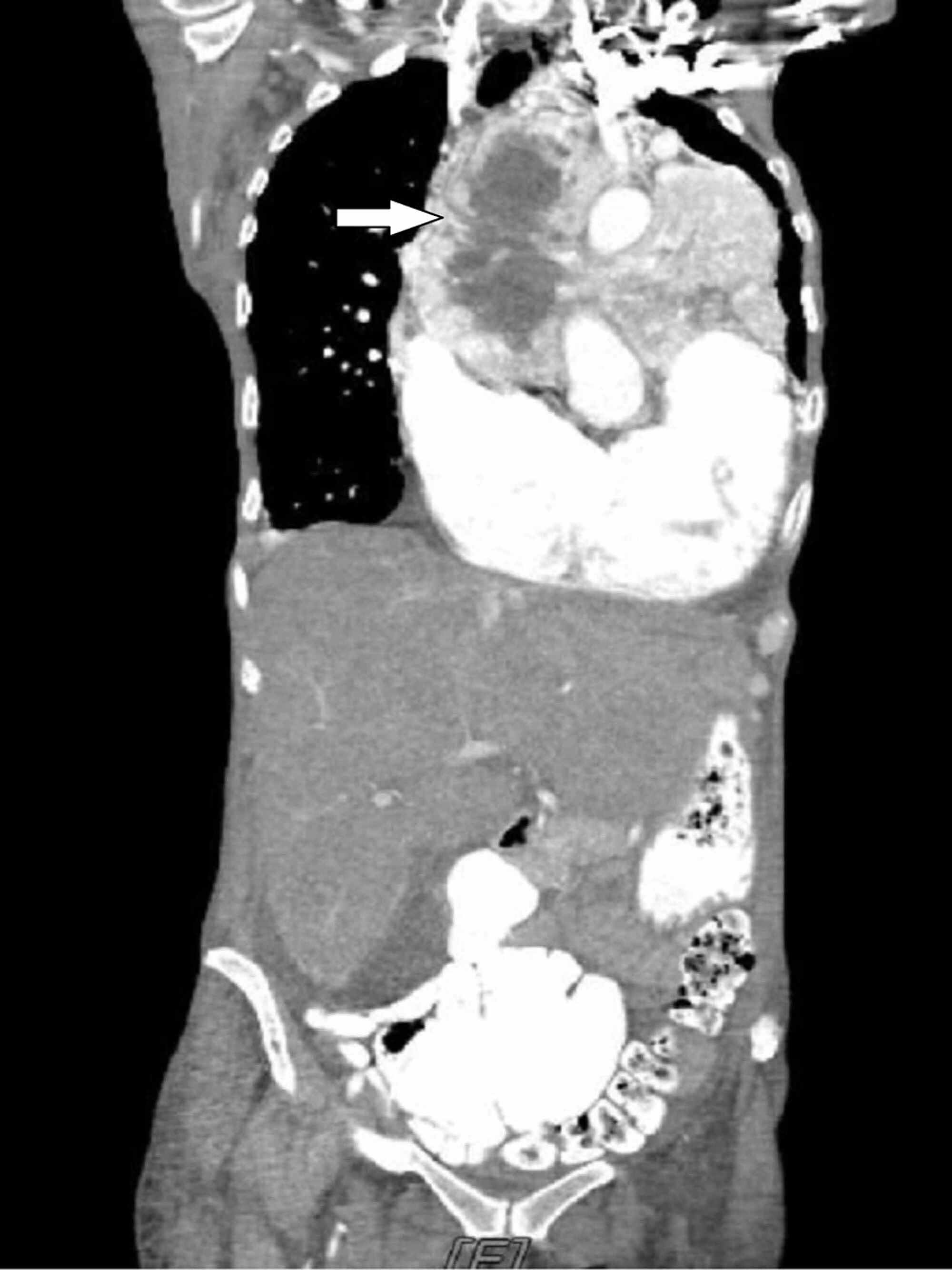 Cureus Rare Acute Presentation of a LowGrade Thymic Neuroendocrine Tumor