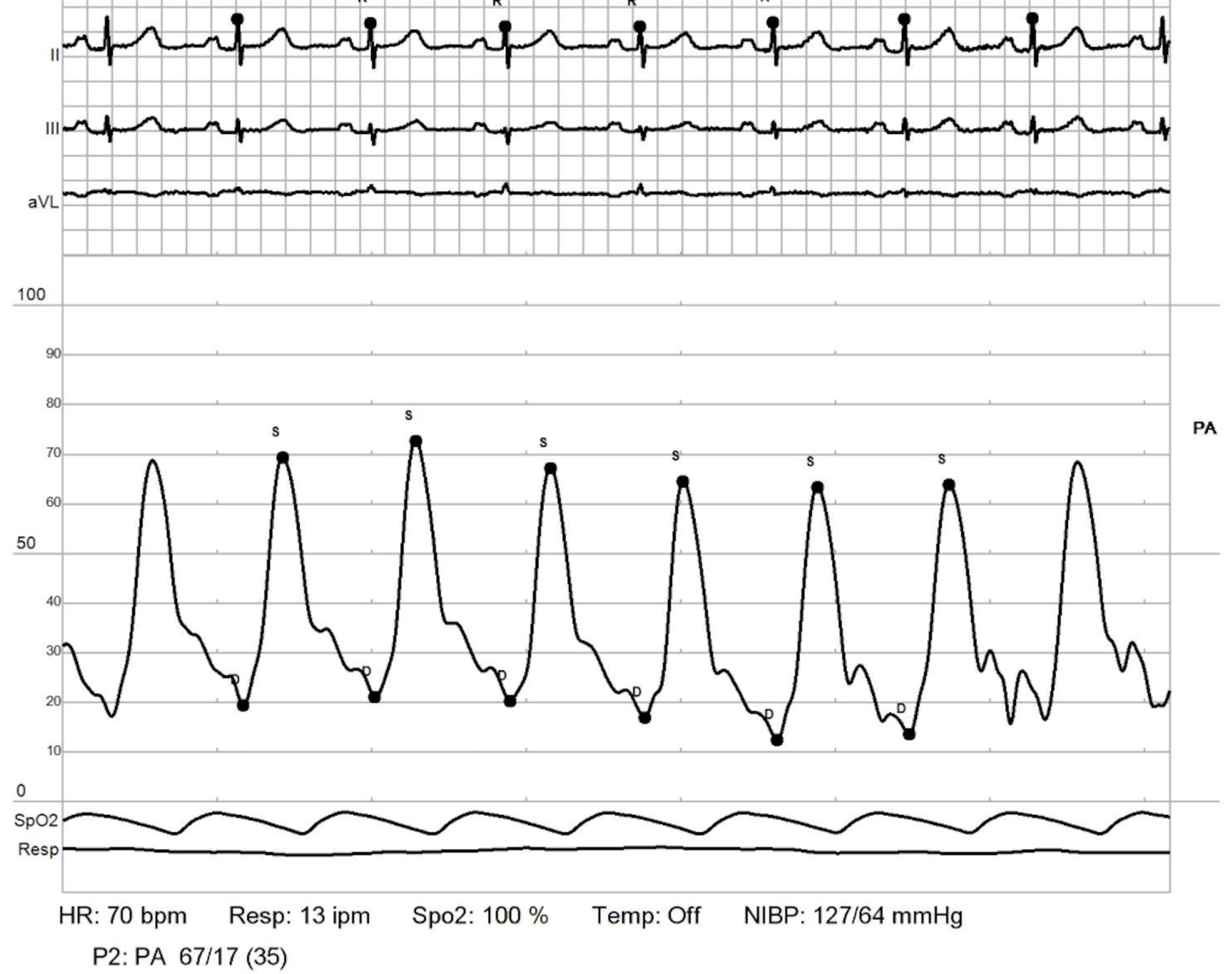 Cureus | Multifactorial Pulmonary Hypertension in Systemic Sclerosis