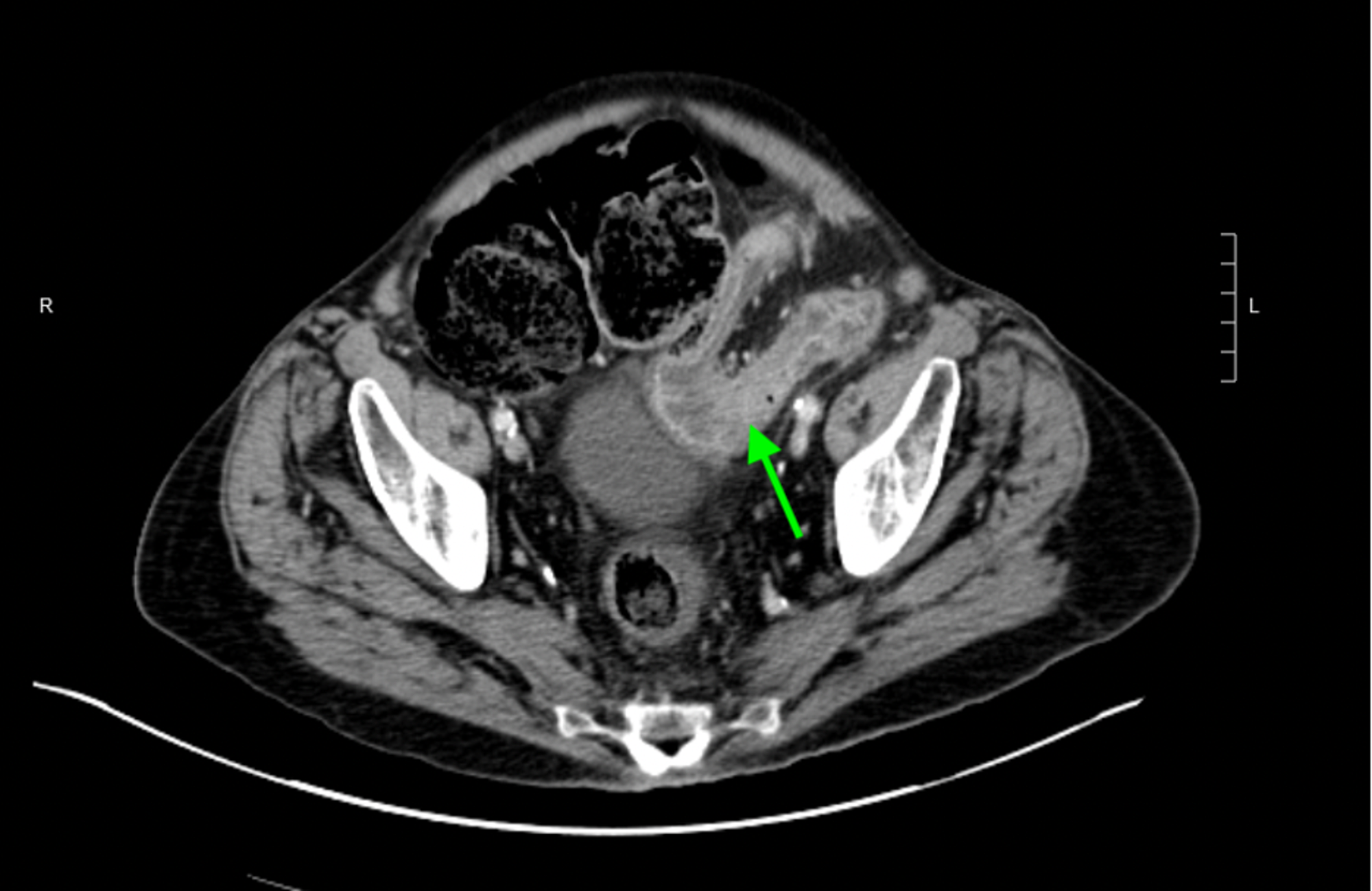 Crohn's Disease CT Scan