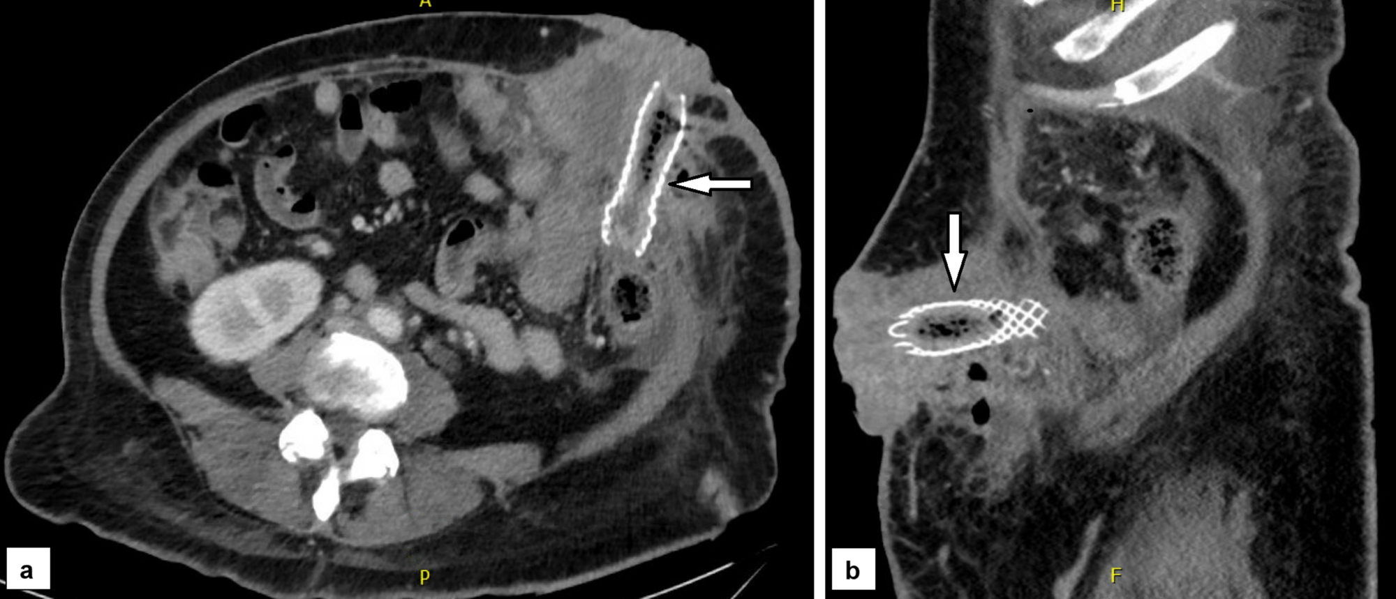 Cureus Metal Stent Insertion for Malignant Obstruction of a Colostomy