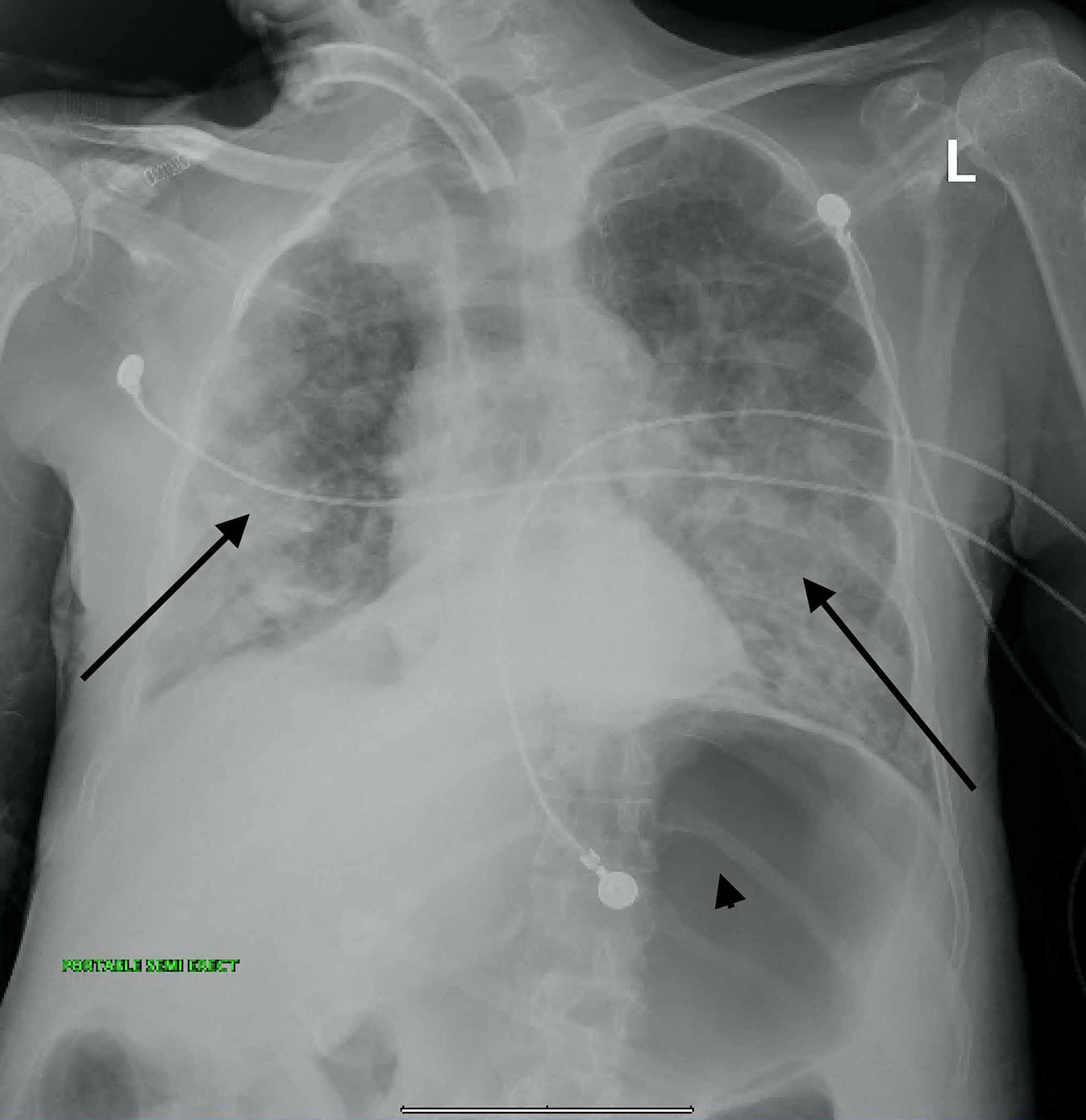 Cureus | A Fatal, Post-Intubation, Tracheoesophageal Fistula