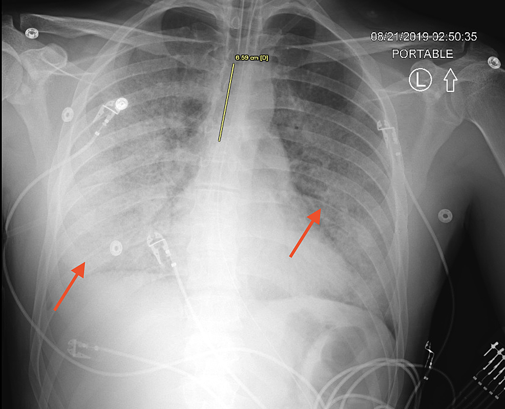 Chest X Ray After Intubation Figure 4 Chest X Ray In vrogue.co