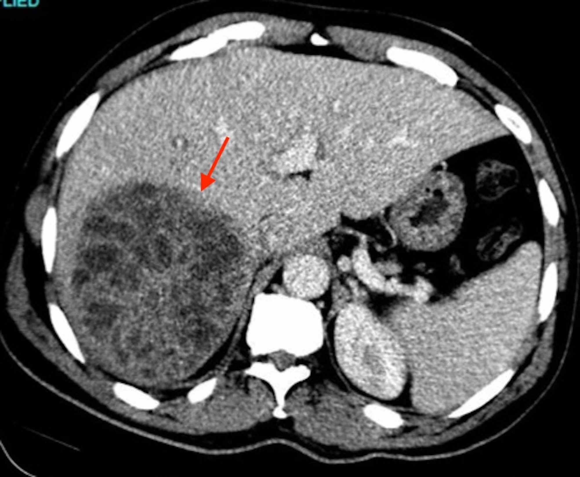 Cureus Complicated Isolated Liver Abscess Caused by Viridans Group
