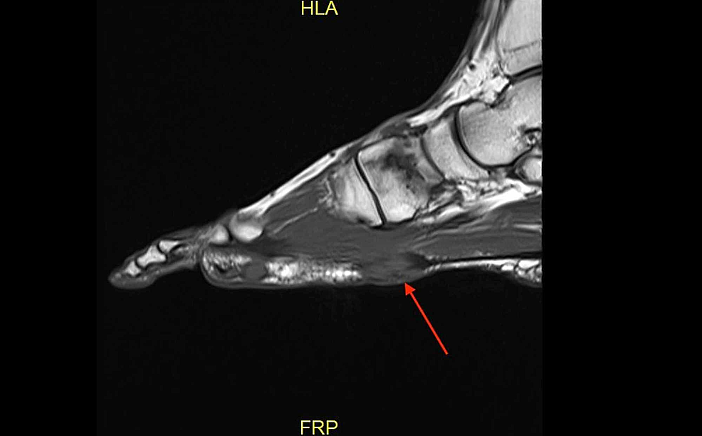 Case-2-MRI-showing-the-sagittal-T1-weighted-image-demonstrating-a-plantar-fibroma-of-the-first-tarsometatarsal-joint.