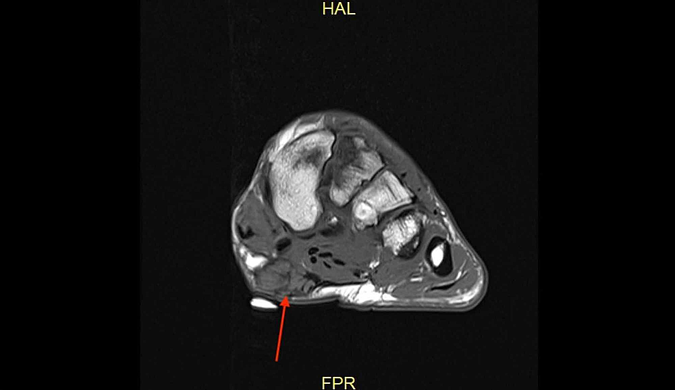 Case-2-MRI-showing-the-axial-T1-weighted-image-of-the-foot-demonstrating-a-plantar-fibroma-of-the-midfoot,-demarcated-with-a-skin-marker-on-the-plantar-aspect-of-the-foot.