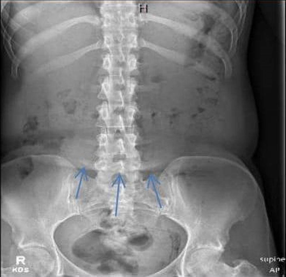 Abdominal-X-ray-demonstrating-curvilinear-lucencies-in-the-pelvis