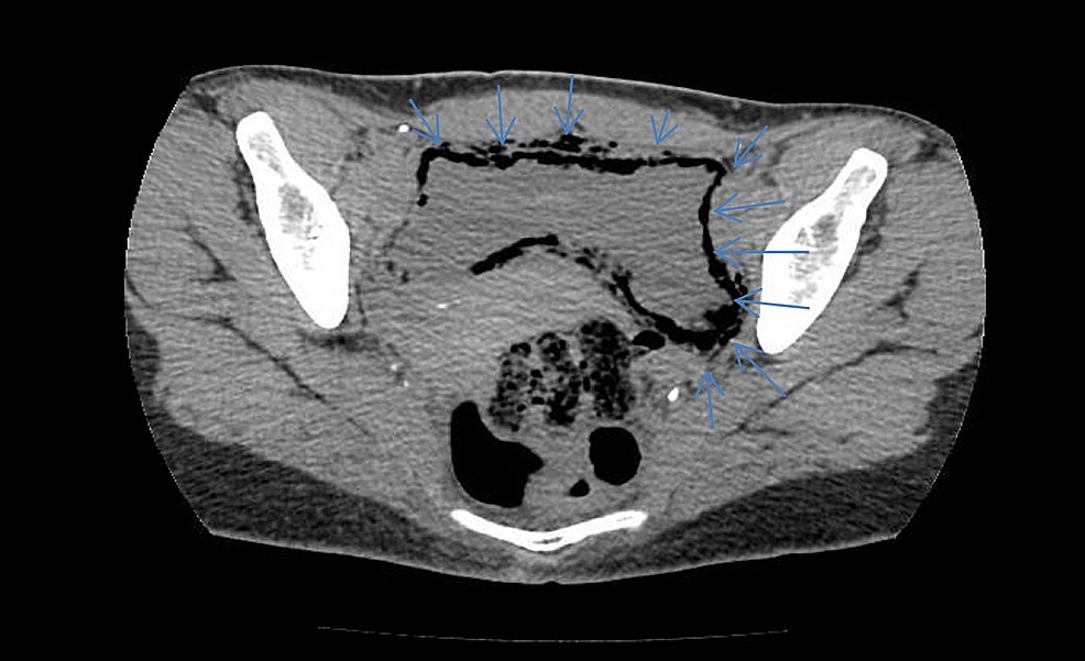 A-CT-scan-of-the-pelvis-and-abdomen-without-contrast-indicating-abnormal-bladder-wall-thickening-that-contained-air-