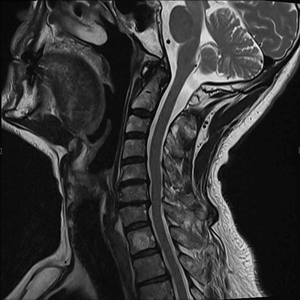 Atypical Presentation of ParsonageTurner Syndrome Cureus