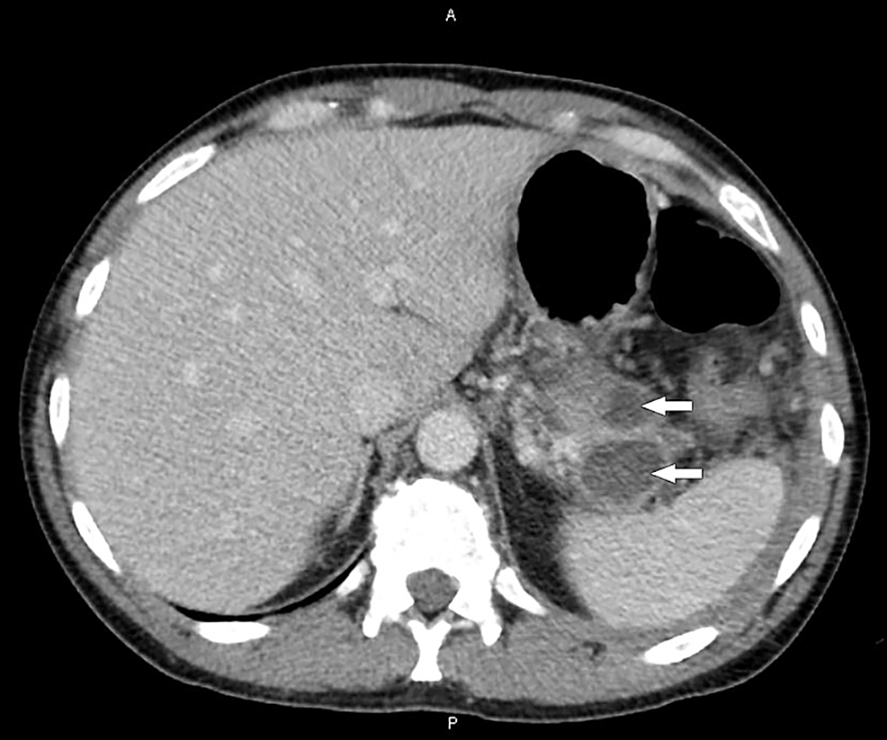 Cureus | Splenic Subcapsular Hematoma Complicating a Case of Pancreatitis