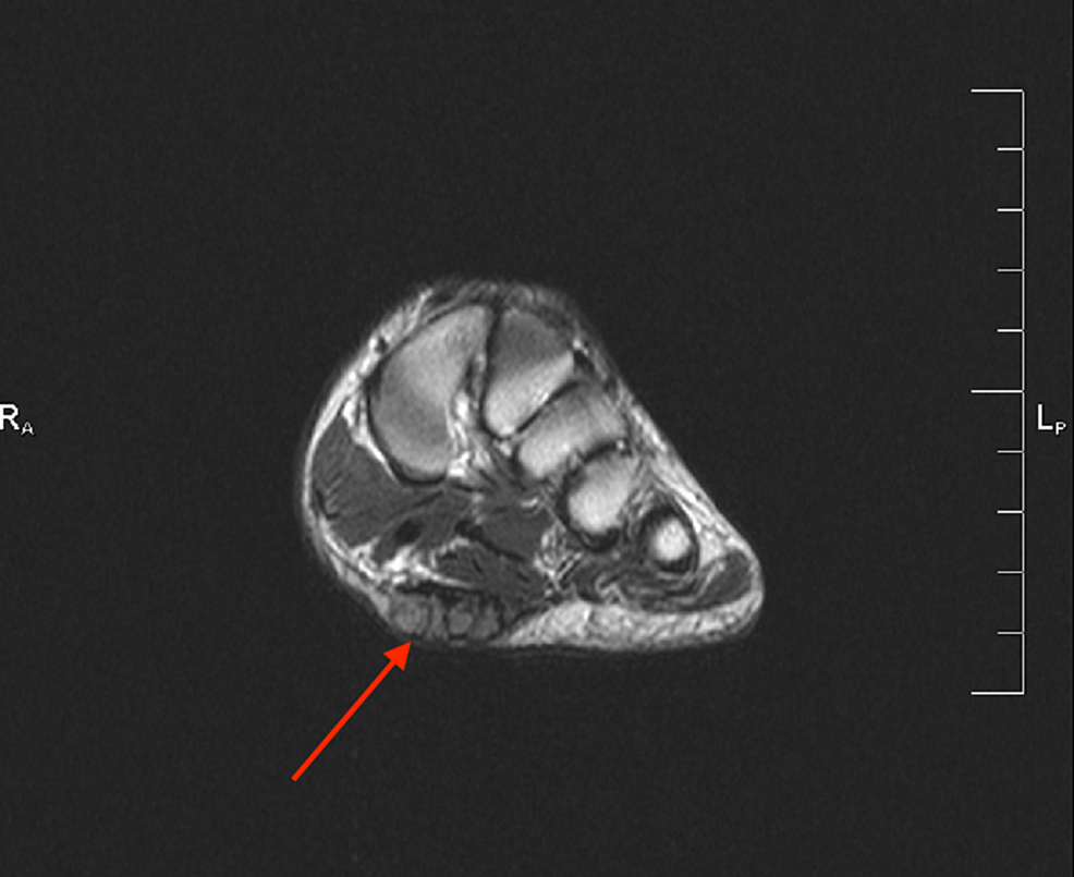 Case-1-MRI-showing-the-axial-T2-weighted-image-of-the-left-foot-demonstrating-a-plantar-fibroma-involving-the-central-and-medial-cords-of-the-plantar-fascia-beginning-at-the-first-tarsometatarsal-joint.