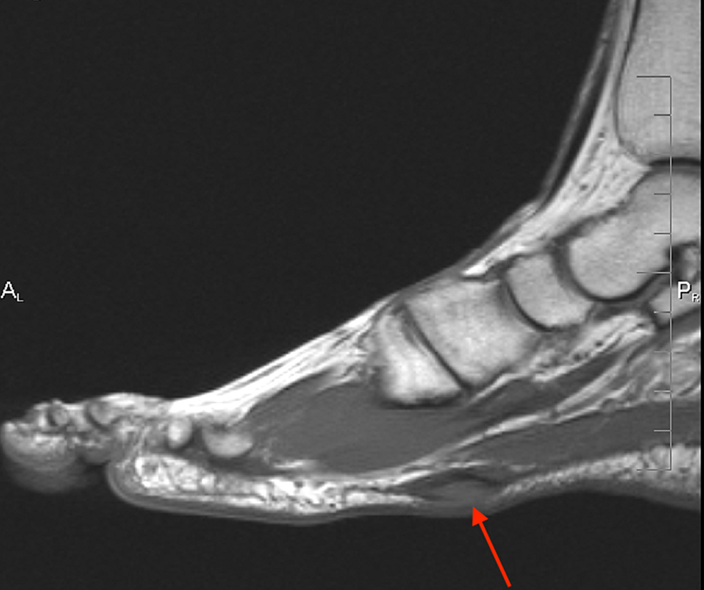 Case-1-MRI-showing-the-sagittal-T1-weighted-image-of-the-left-foot-demonstrating-a-plantar-fibroma-starting-at-the-first-tarsometatarsal-joint-with-no-involvement-of-the-plantar-musculature-or-flexor-tendons.