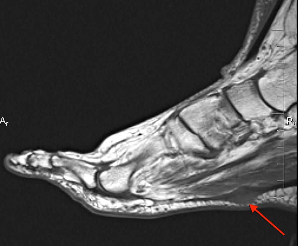 plantar fascia fibroma