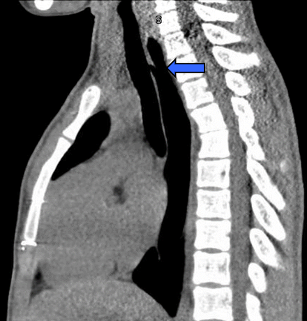 CT-scan-of-chest-without-contrast,-sagittal-view,-demonstrating-TEF-(blue-arrow).