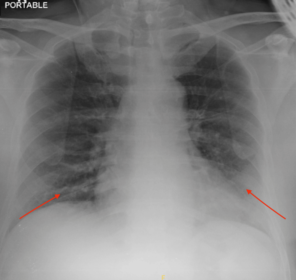 Increased-reticular-opacities-at-both-lower-zones-(arrows)-suggestive-of-lung-infection.