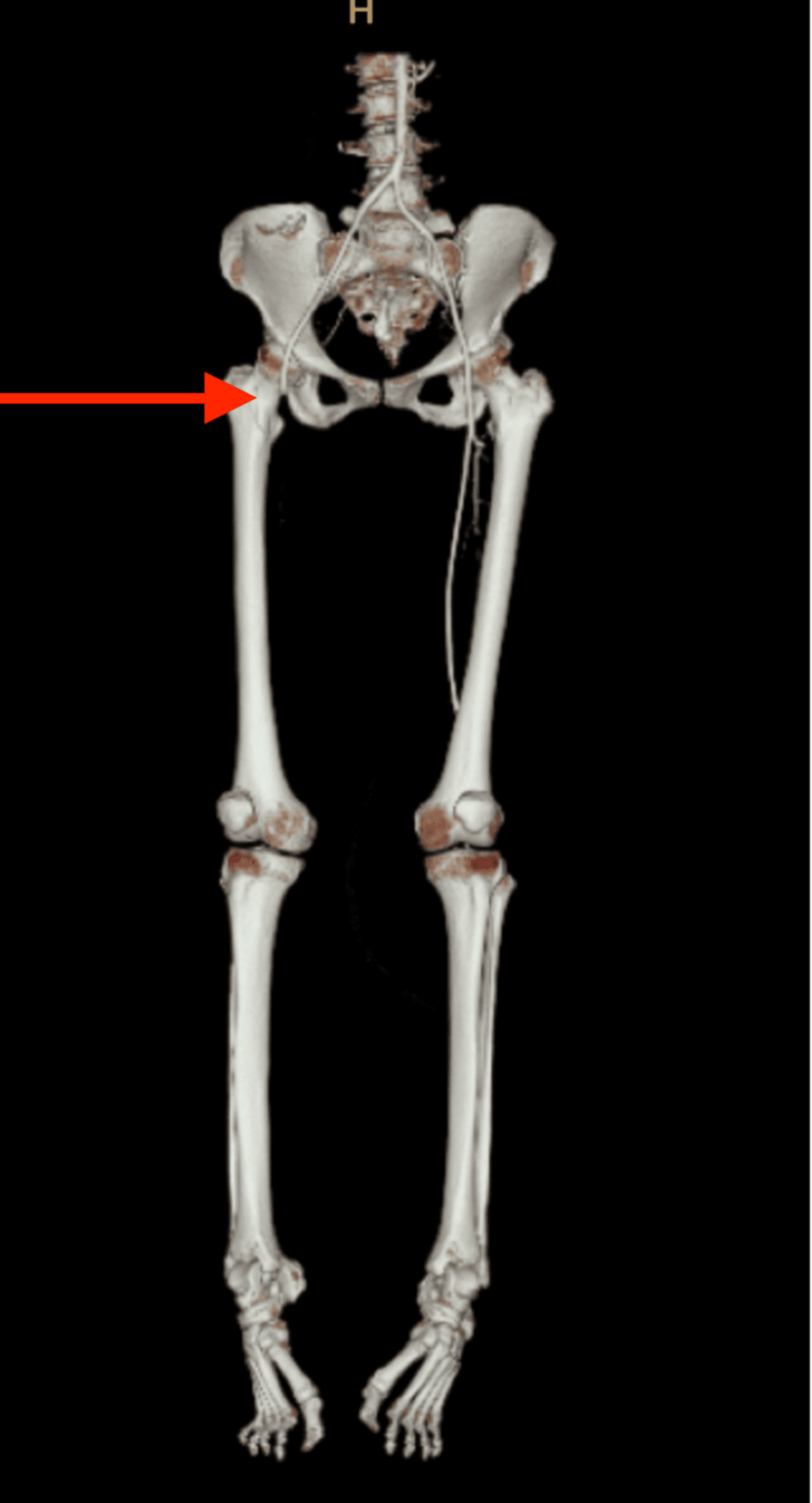 Long-segment-of-acute-thrombosis-of-right-lower-limb-arteries-involving-right-common-femoral-artery-until-distally-(arrow).