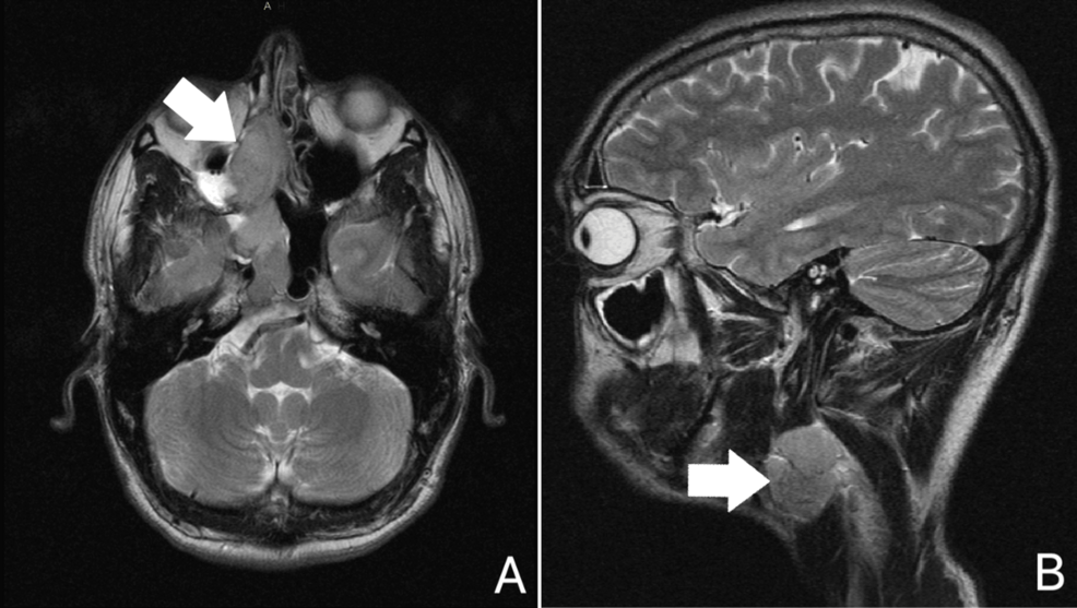 Tumor Rare variant of large pediatric glioneuronal tumor with