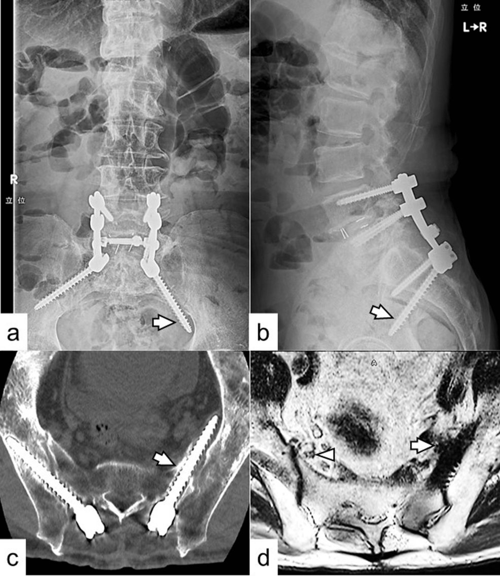 bpc 157 sciatica reddit A Misplaced S2 Alar-Iliac Screw Causing L5 Spinal Nerve Injury: A Report of  a Rare Case