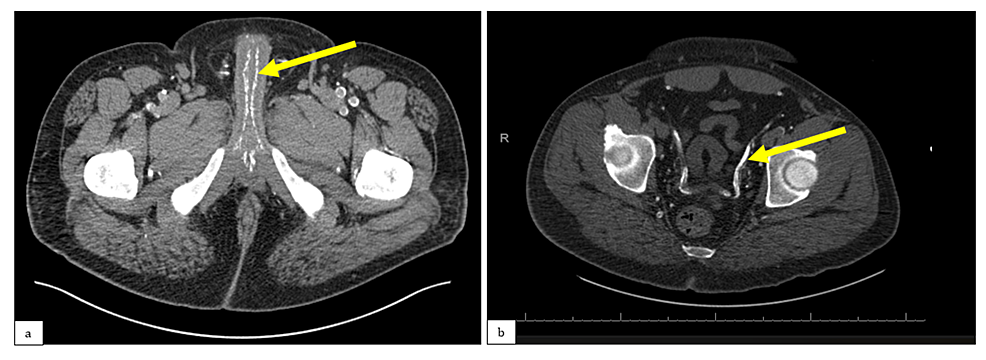 a)-Non-contrast-CT-scan-showing-extensive-calcification-of-the-cavernosal-arteries-(yellow-arrow);-b)-non-contrast-CT-scan-showing-calcification-of-the-vas-deferens-(yellow-arrow)