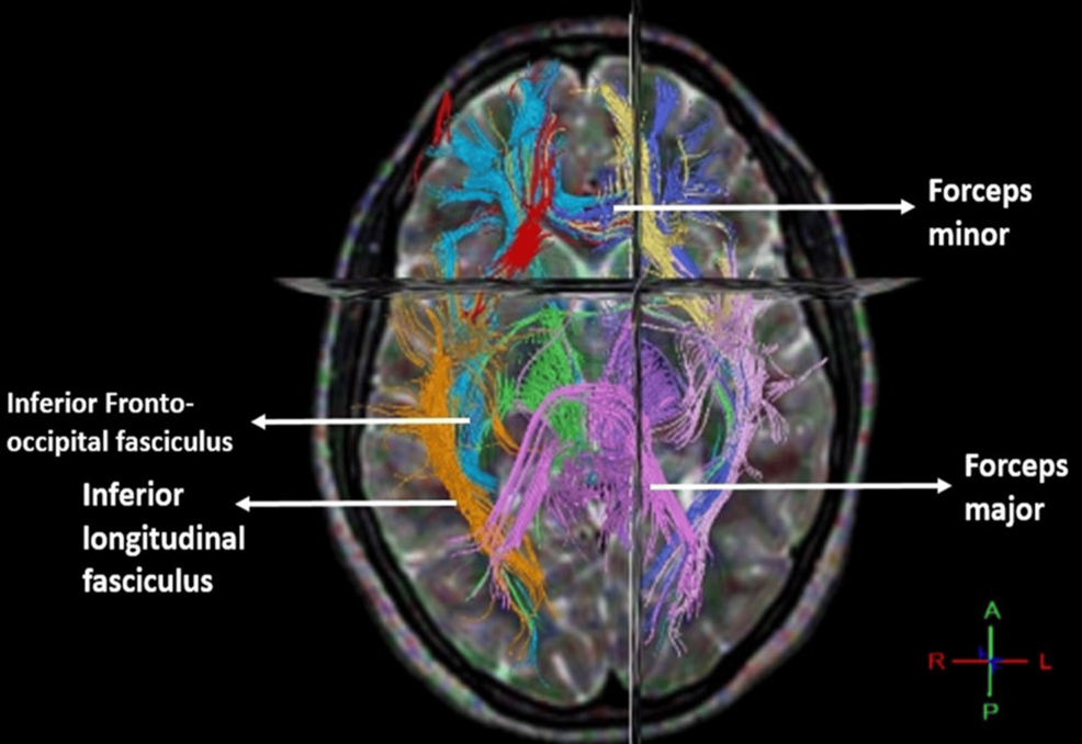 洋書 Introduction to diffusion tensor imaging Introduction to Diffusion Tensor Imaging | ScienceDirect