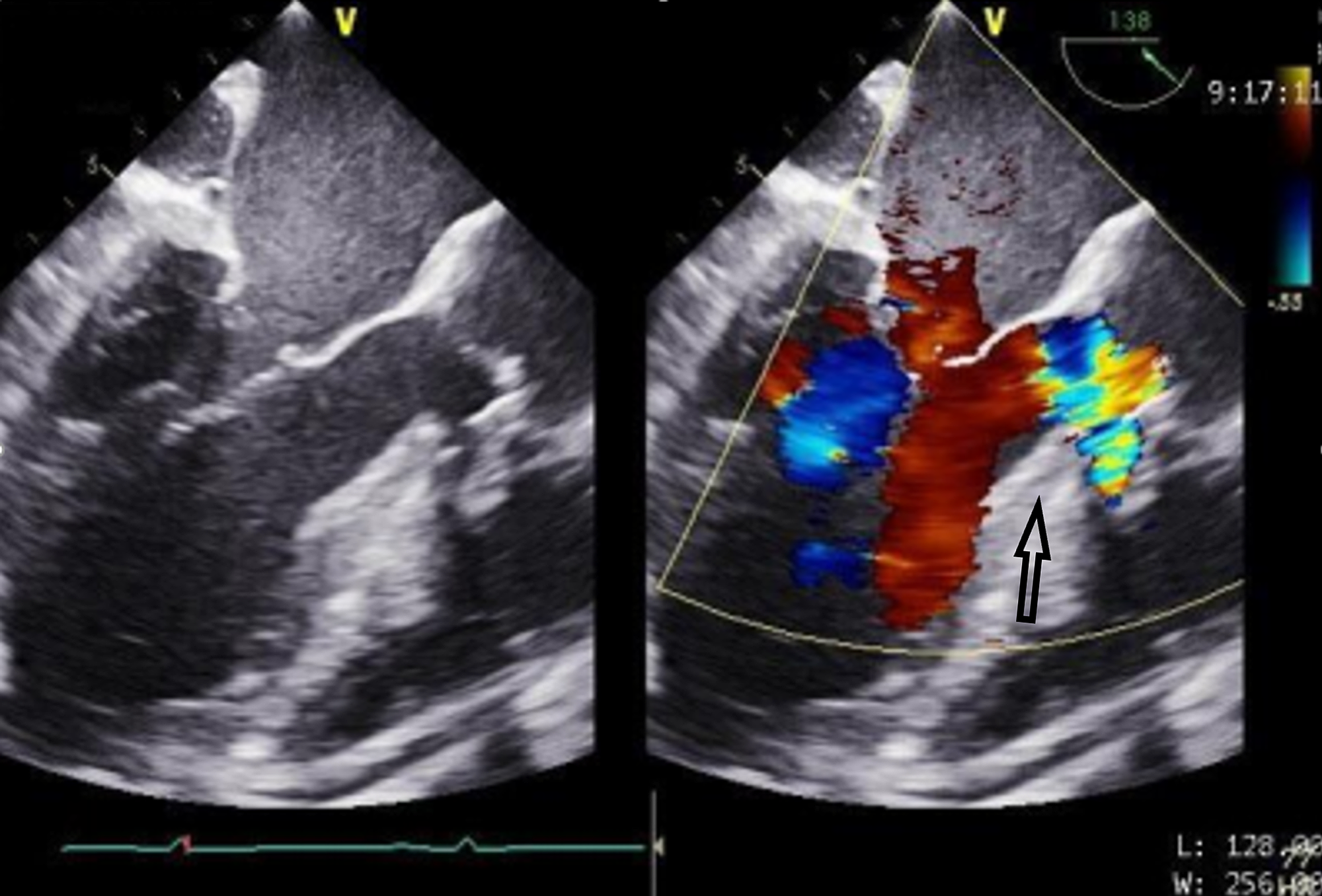 Cureus | Repair of a Supracristal Ventricular Septal Defect in an Adult