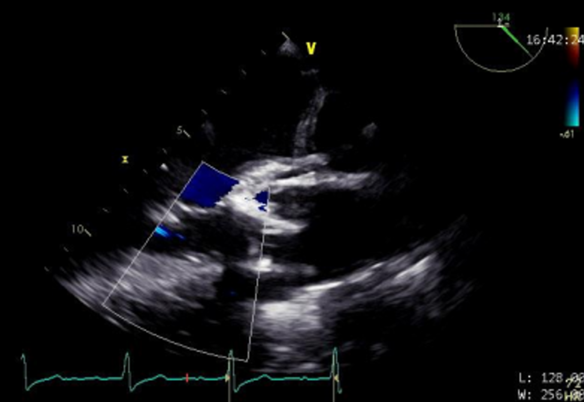 Cureus | Repair of a Supracristal Ventricular Septal Defect in an Adult