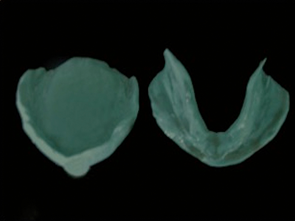 Cureus Improvised Neutral Zone Technique in a Completely Edentulous