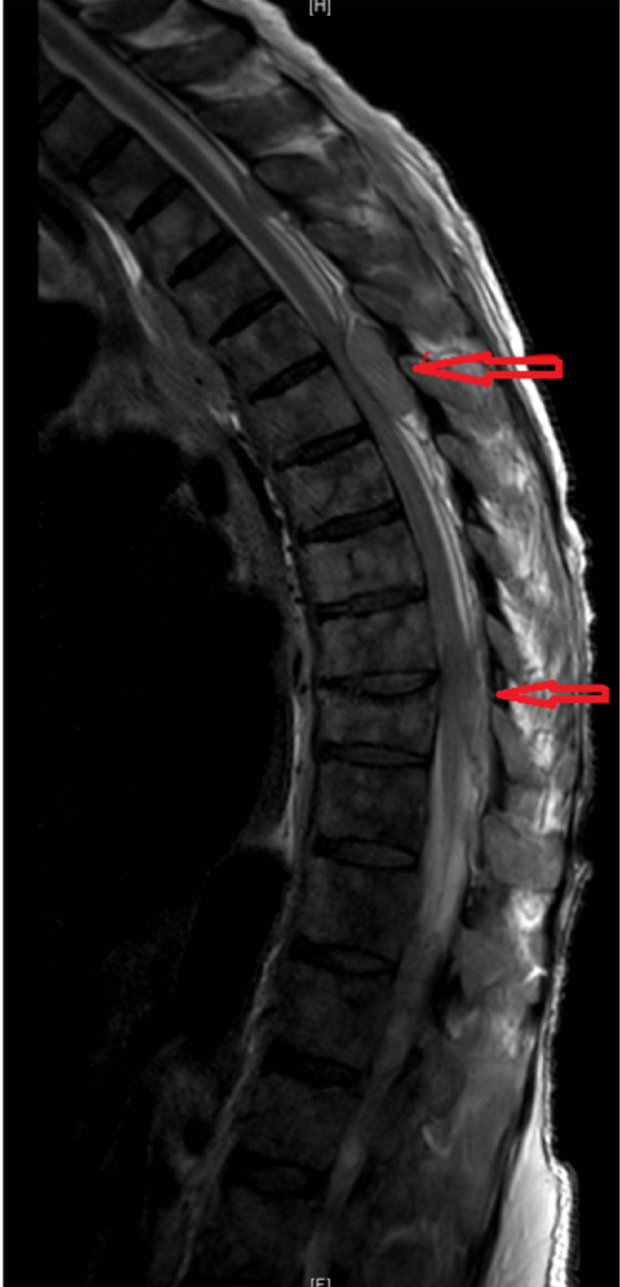 Cureus A Rare Case Of Acute Cord Compression From Spinal Myeloid 8171