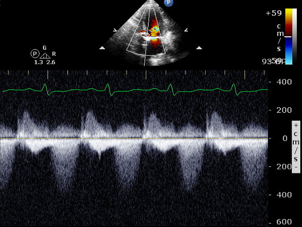 cureus-catastrophic-cardiac-complications-of-takayasu-s-arteritis