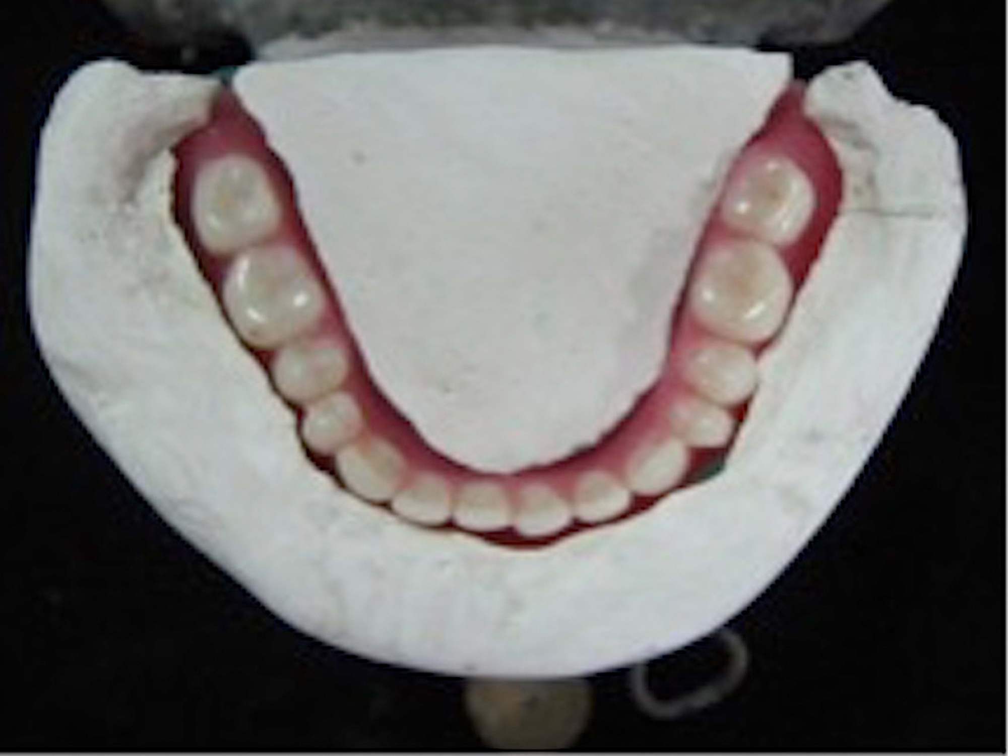 Cureus Improvised Neutral Zone Technique in a Completely Edentulous