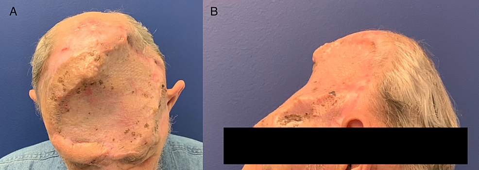 Cureus Placement Of Dermal Regeneration Template On Fibrotic Dura