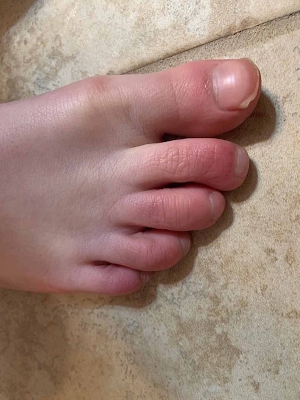 What Helps Chilblains On Feet