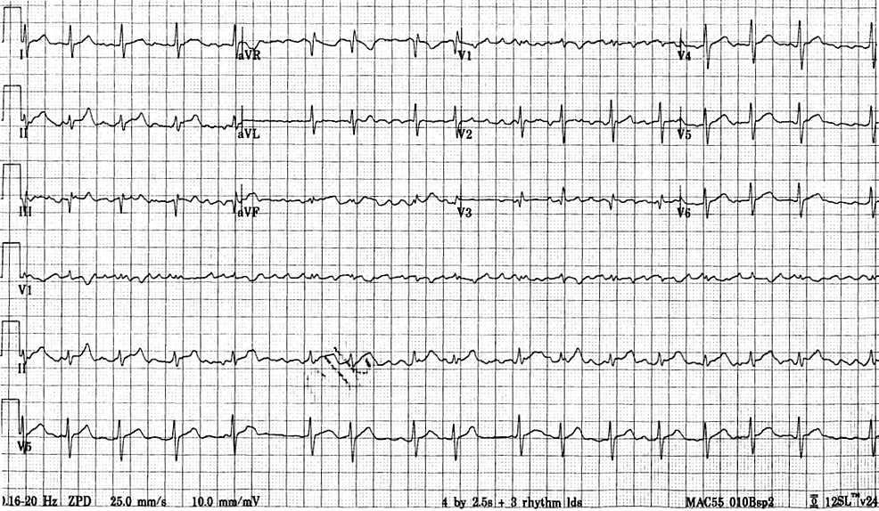 atrial fibrillation ivcd