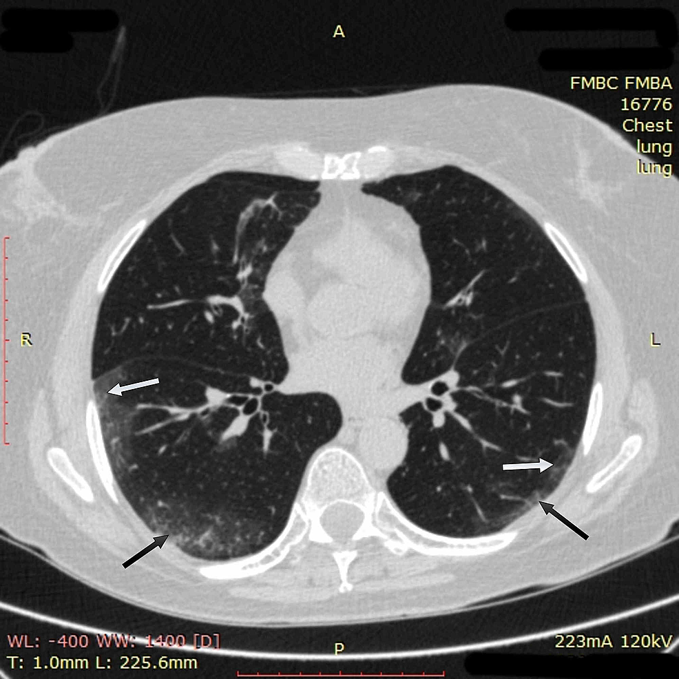 potilaan rintakehän CT-kuvantaminen-1-on-sisäänotto