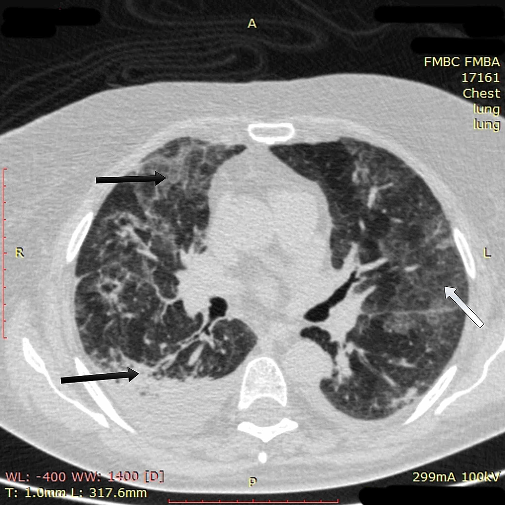 potilaan rintakehän CT-kuvantaminen-1-päivänä-17